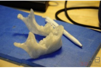3D печать в медицине, модель челюсти для последующего создания протеза